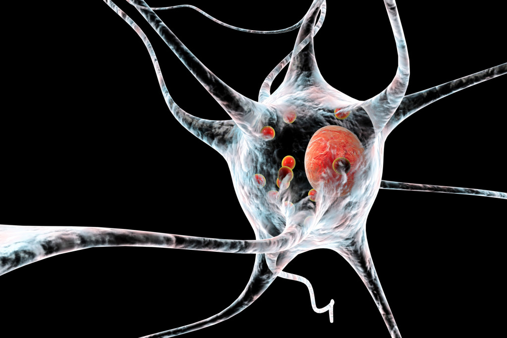 Parkinson's disease nerve cells, illustration