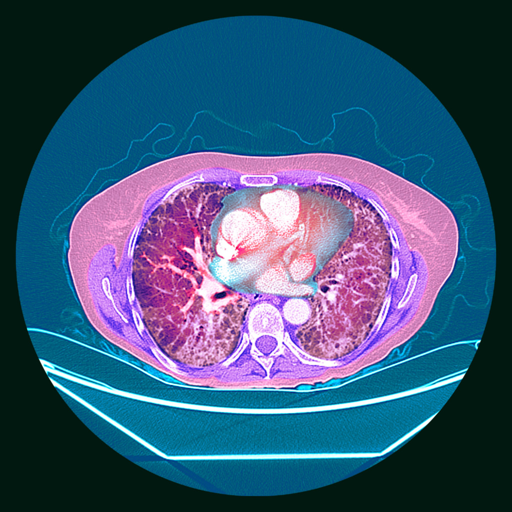Pulmonary fibrosis, coloured CT scan