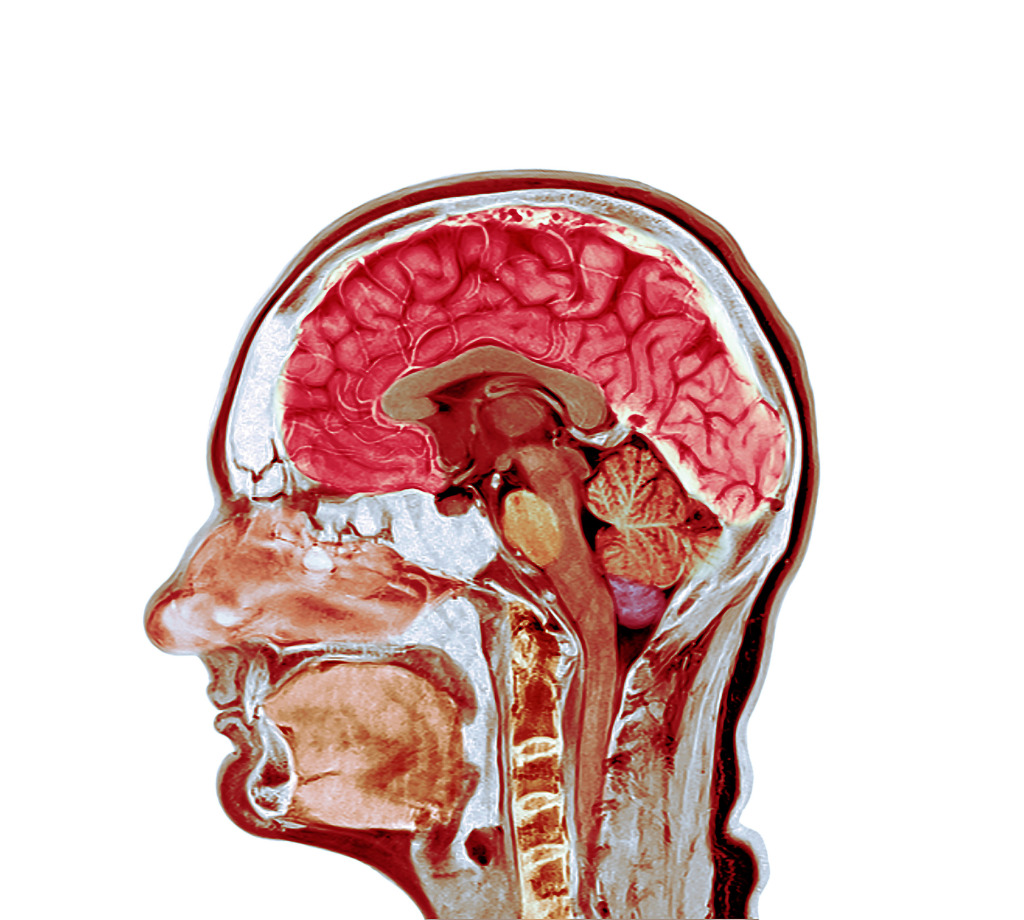 Healthy brain, MRI scan