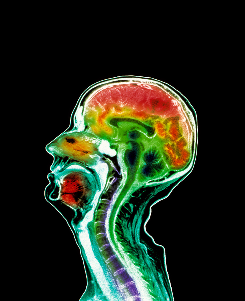 Brain atrophy, MRI scan