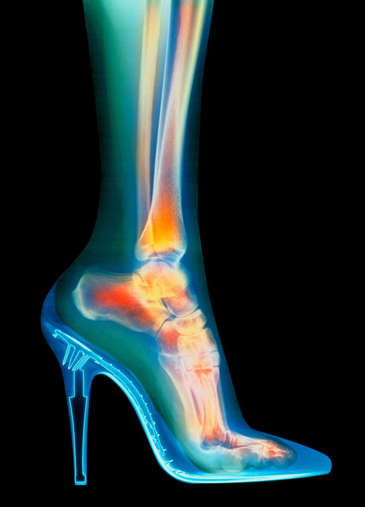 Woman's foot in high-heel shoe, X-ray