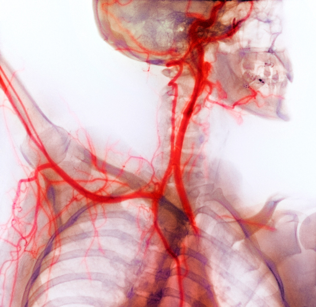 Neck and shoulder arteries, X-ray