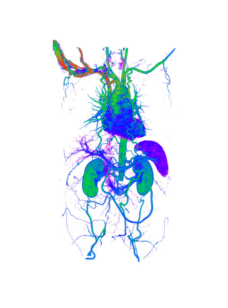 Aortoiliac occlusive disease, 3D CT scan