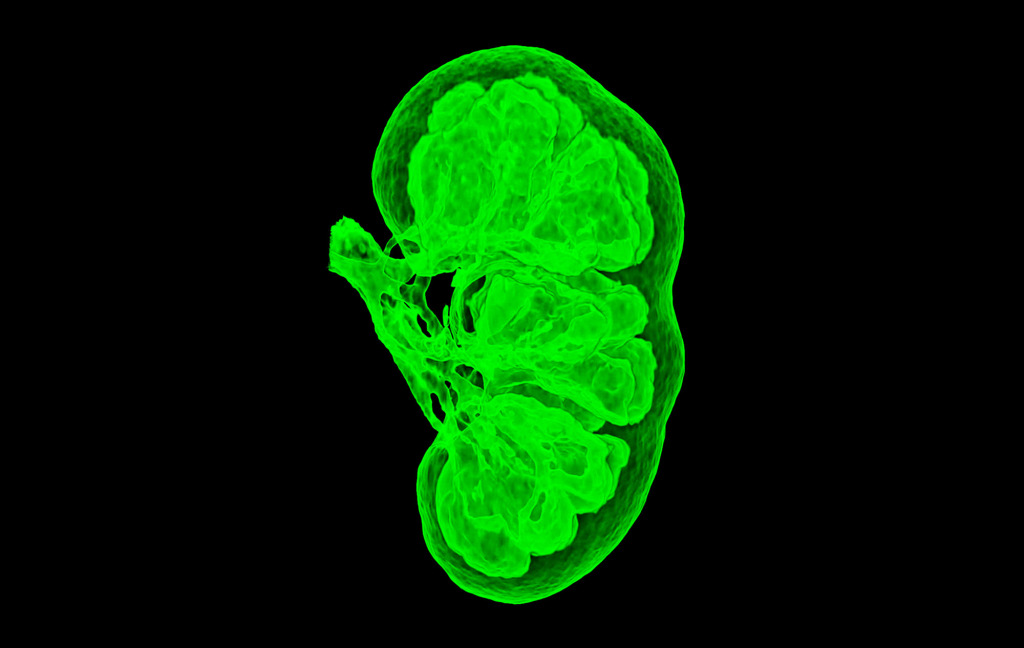 Kidney, CT scan