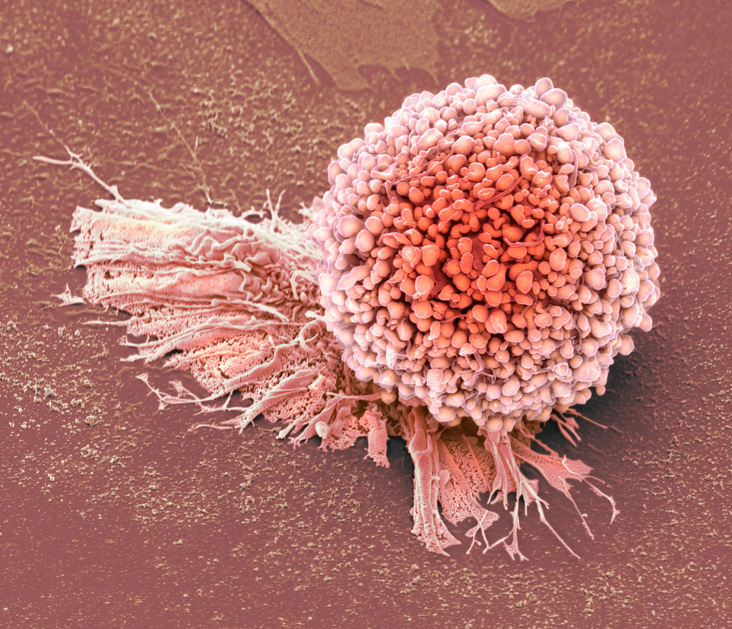 Cervical cancer cell, SEM