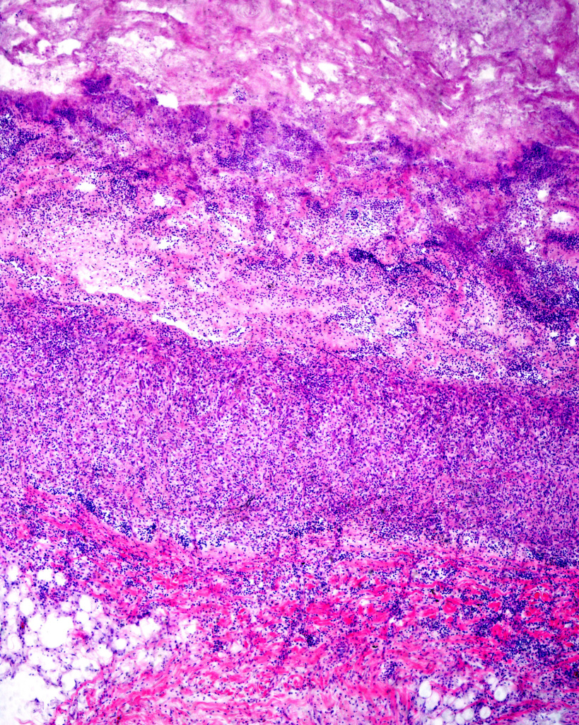 Chronic endocarditis in human heart, light micrograph