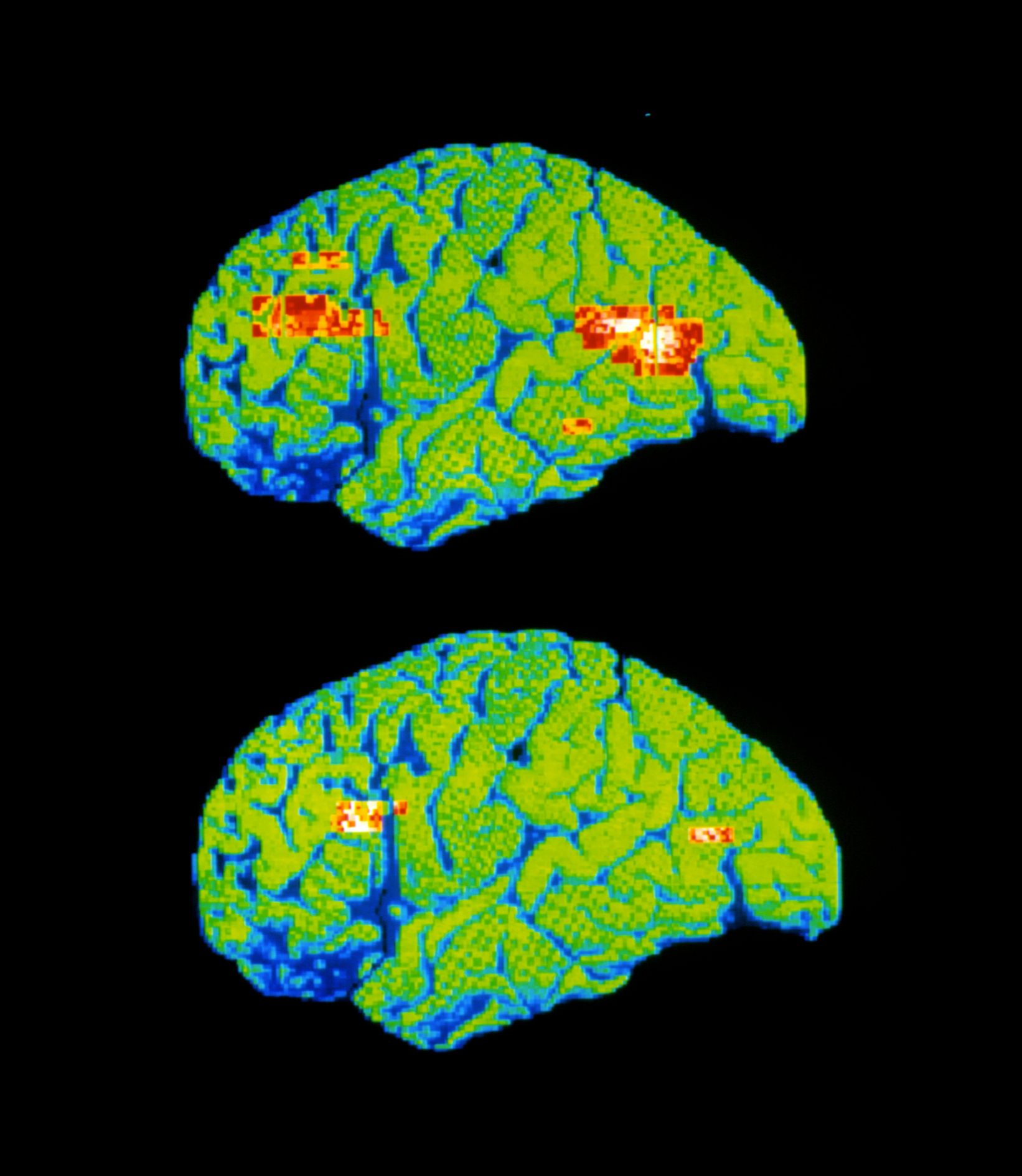 Routine brain scanning may improve clinical care for people with psychosis